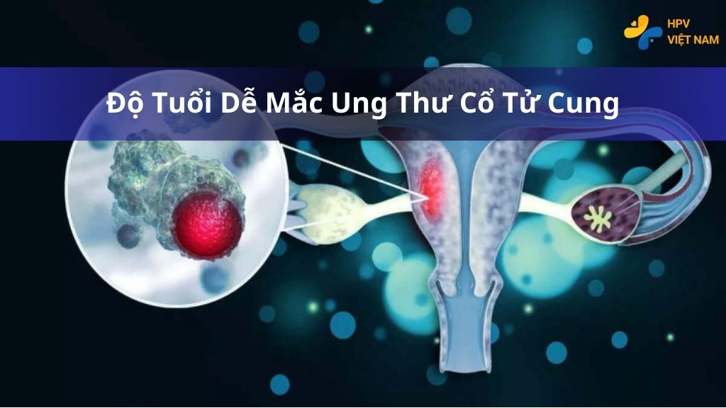 Độ tuổi dễ mắc ung thư cổ tử cung