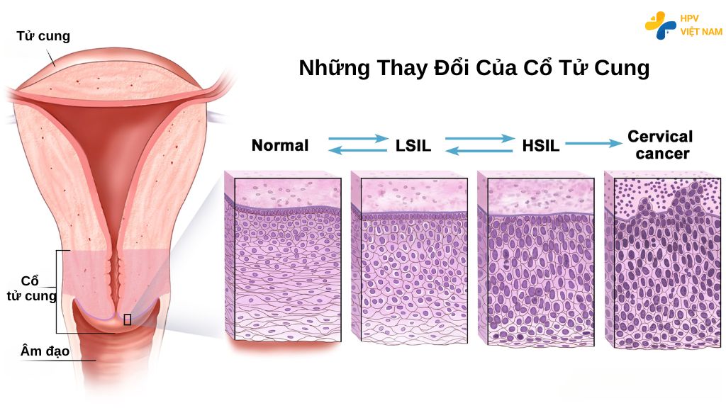 HSIL là gì? Có gây ung thư cổ tử cung không?