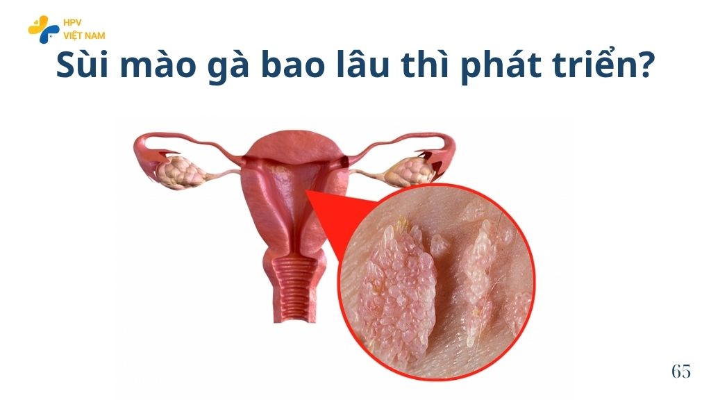 Sùi mào gà bao lâu thì phát triển?