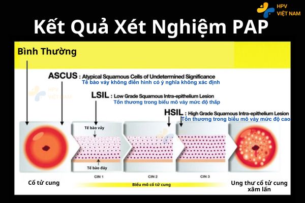 Tế bào Ascus là kết quả xét nghiệm PAP