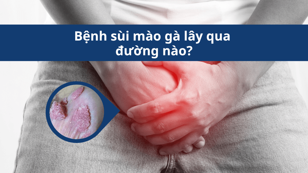 Bệnh sùi mào gà lây qua đường nào