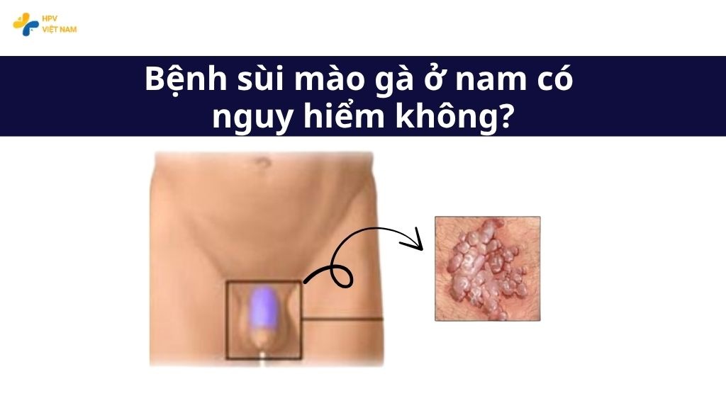 Bệnh sùi mào gà ở nam có nguy hiểm không