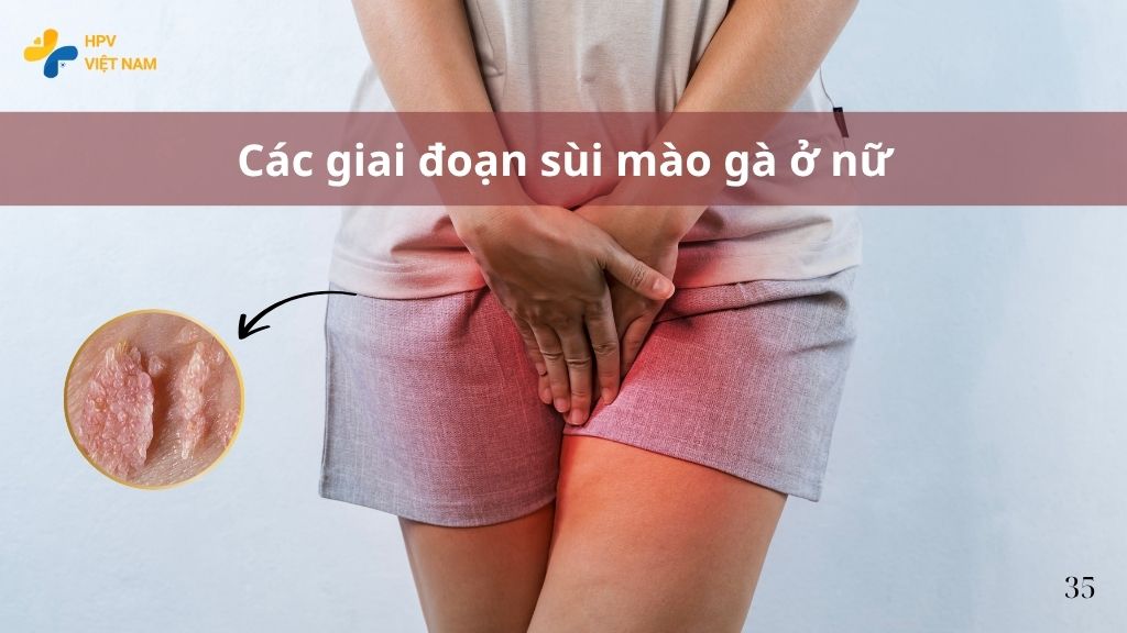 Các giai đoạn sùi mào gà ở nữ