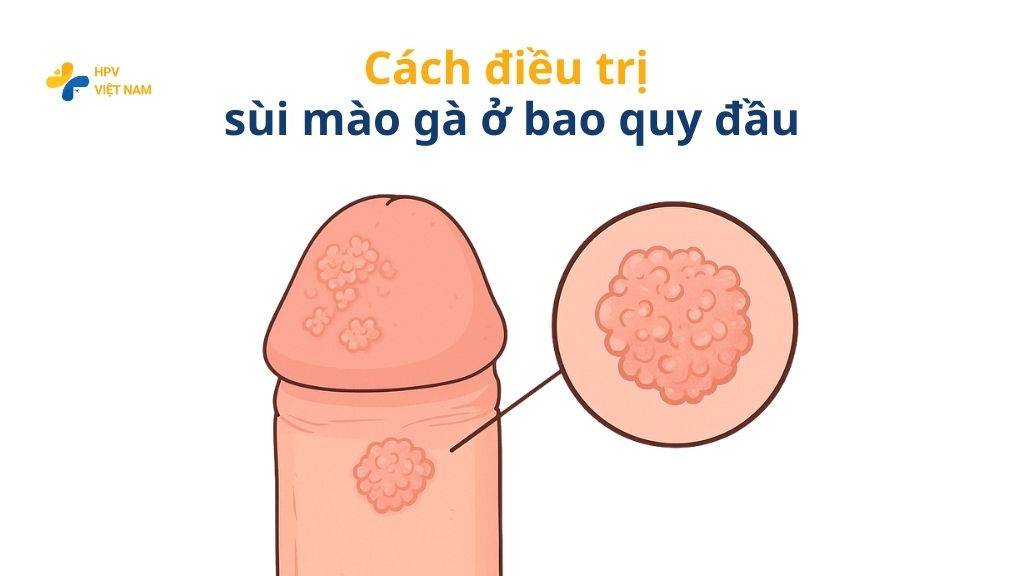 Cách điều trị sùi mào gà ở bao quy đầu
