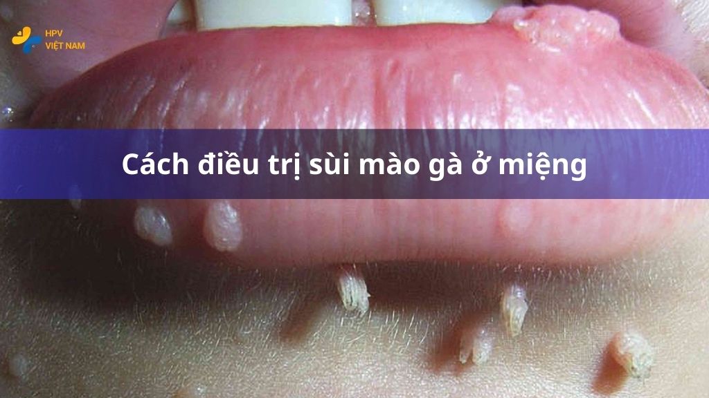 Cách điều trị sùi mào gà ở miệng