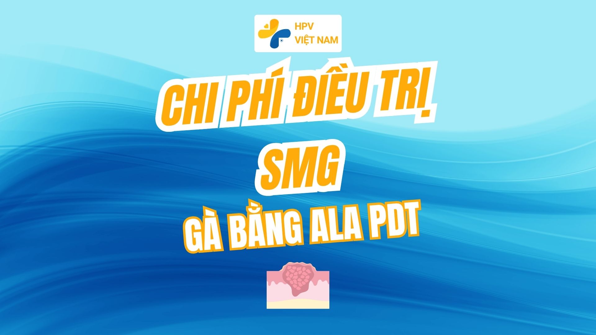 Chi phí điều trị sùi mào gà bằng ALA-PDT