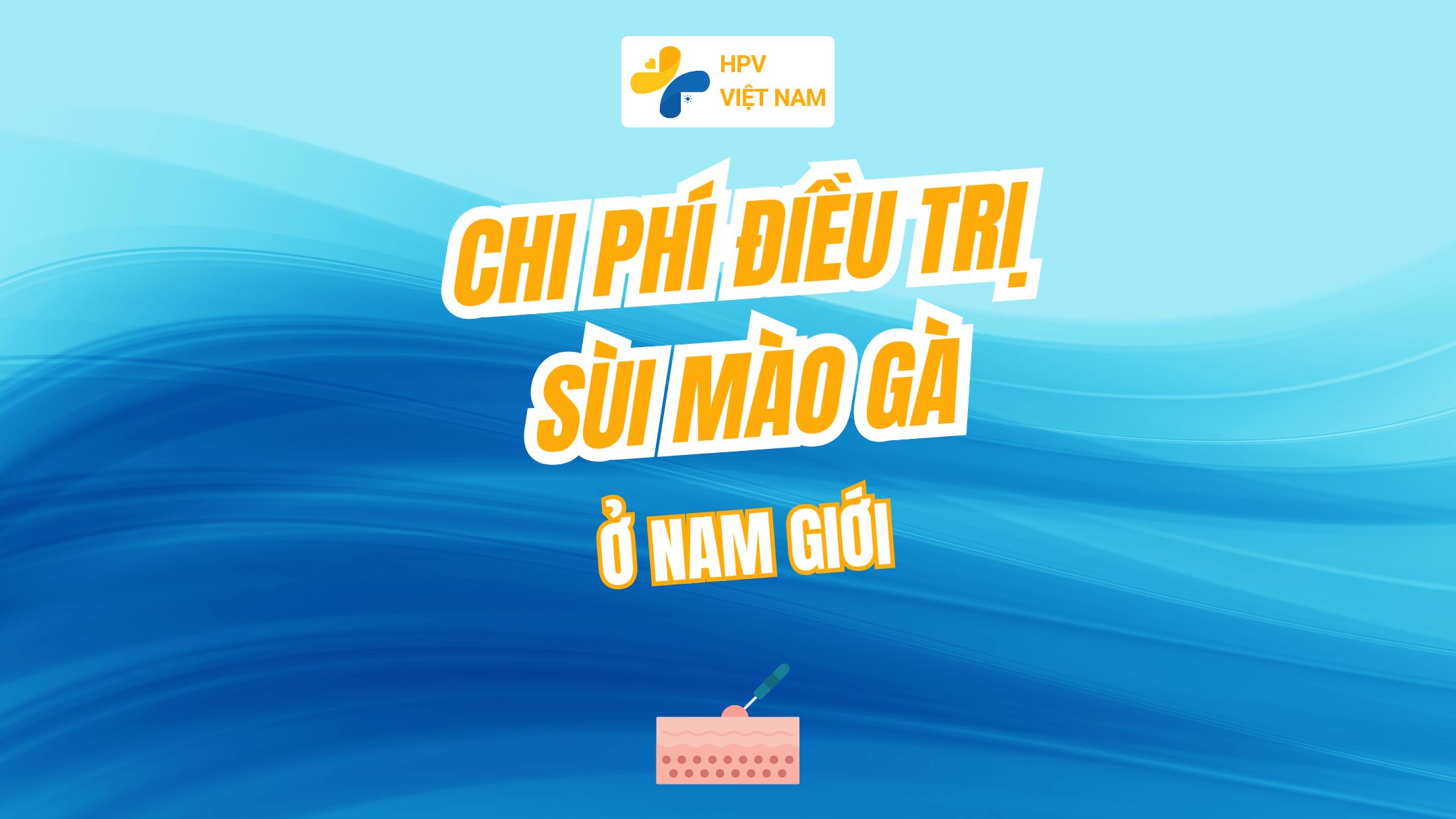 chi phí điều trị sùi mào gà ở nam giới