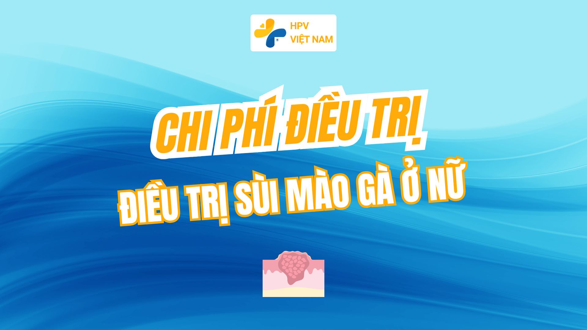 Chi phí điều trị sùi mào gà ở nữ