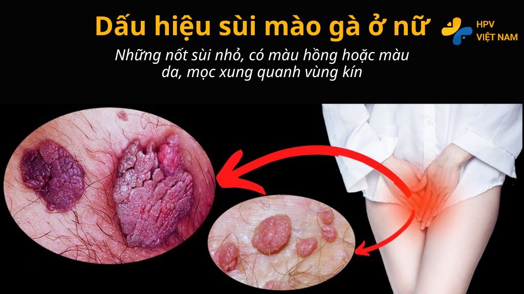 Dấu hiệu sùi mào gà ở nữ