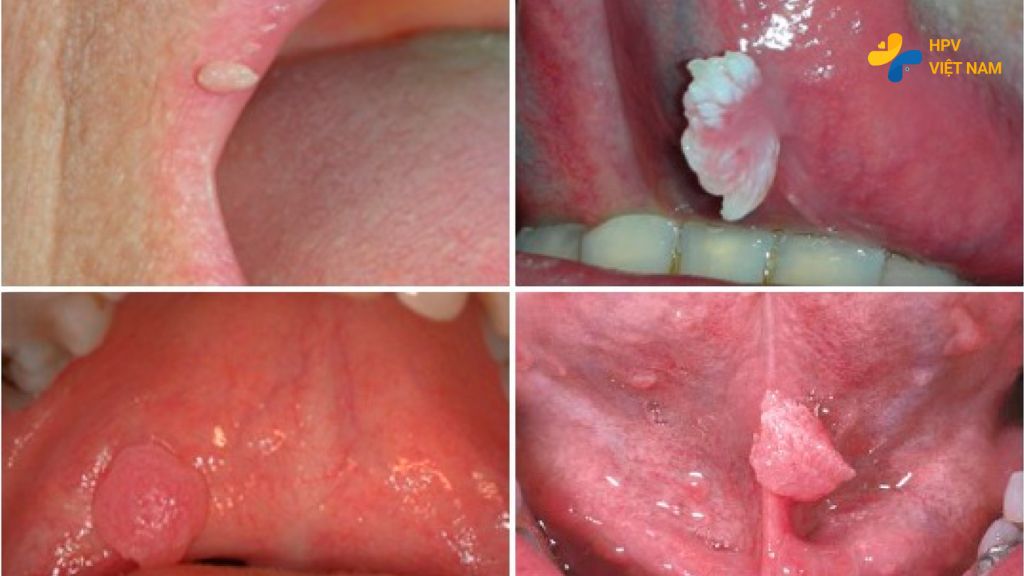 Dấu hiệu sùi mào gà ở miệng