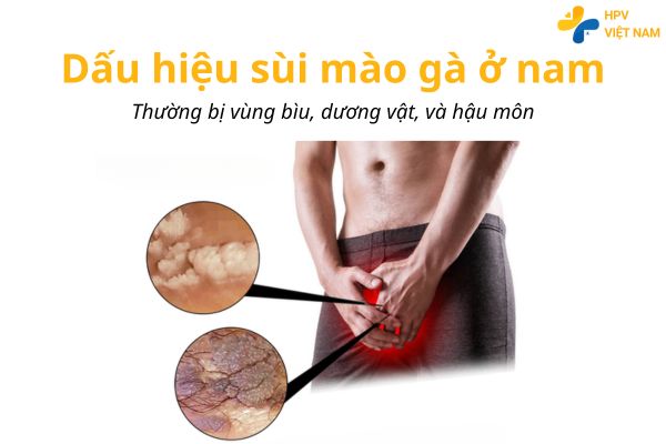 Các dấu hiệu sùi mào dễ nhận thấy ở nam
