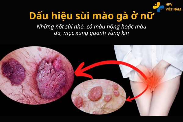 Hình ảnh các dấu hiệu sùi mào gà ở nữ