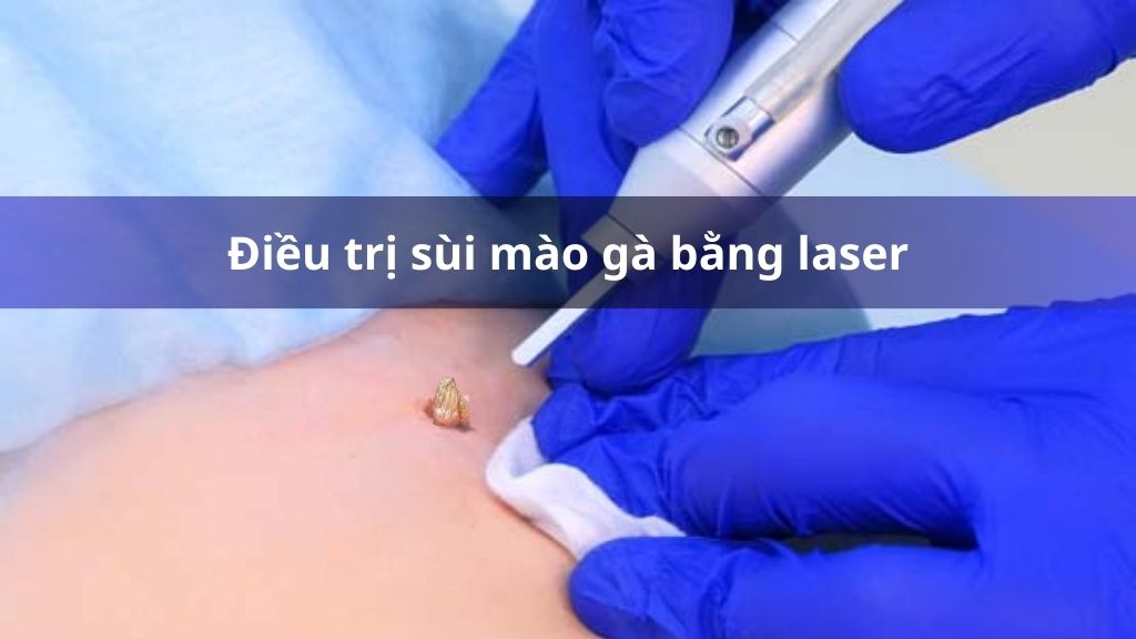 Điều trị sùi mào gà bằng laser