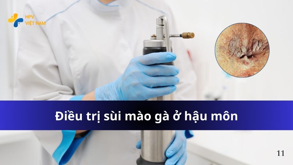Điều trị sùi mào gà ở hậu môn