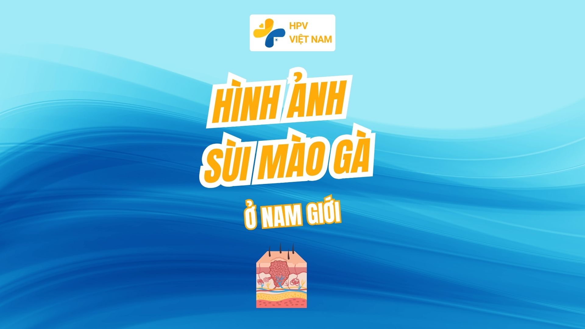 Hình ảnh đàn ông bị sùi mào gà