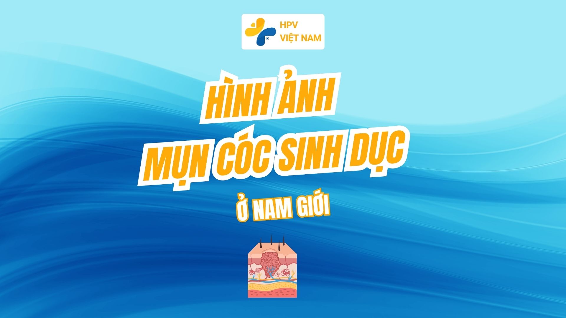 Hình ảnh mụn cóc sinh dục ở nam