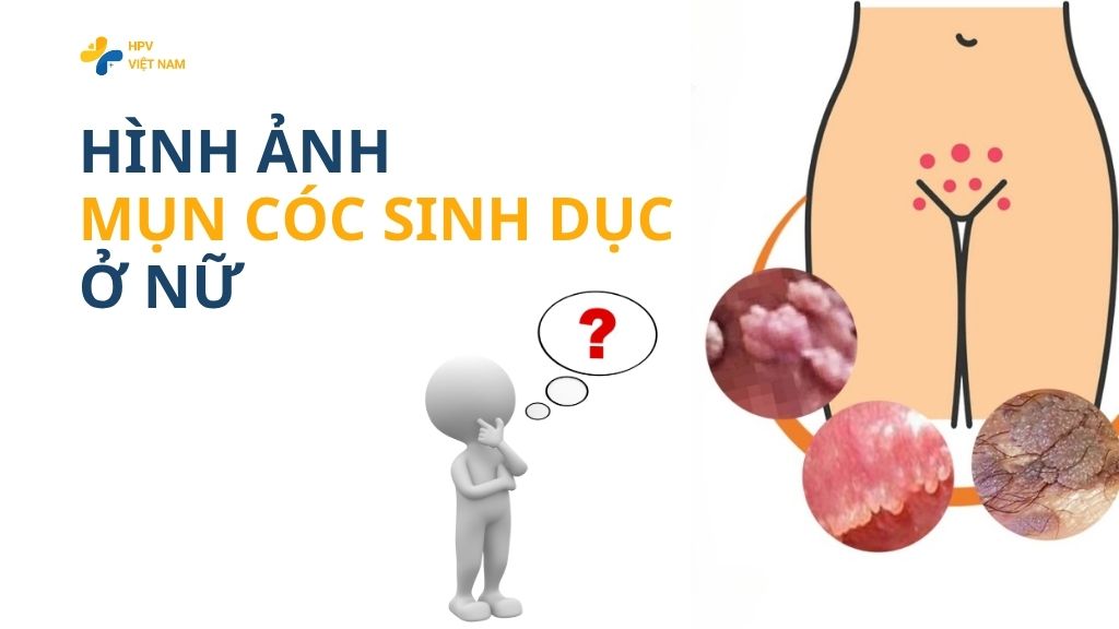 Hình ánh mụn cóc sinh dục ở nữ