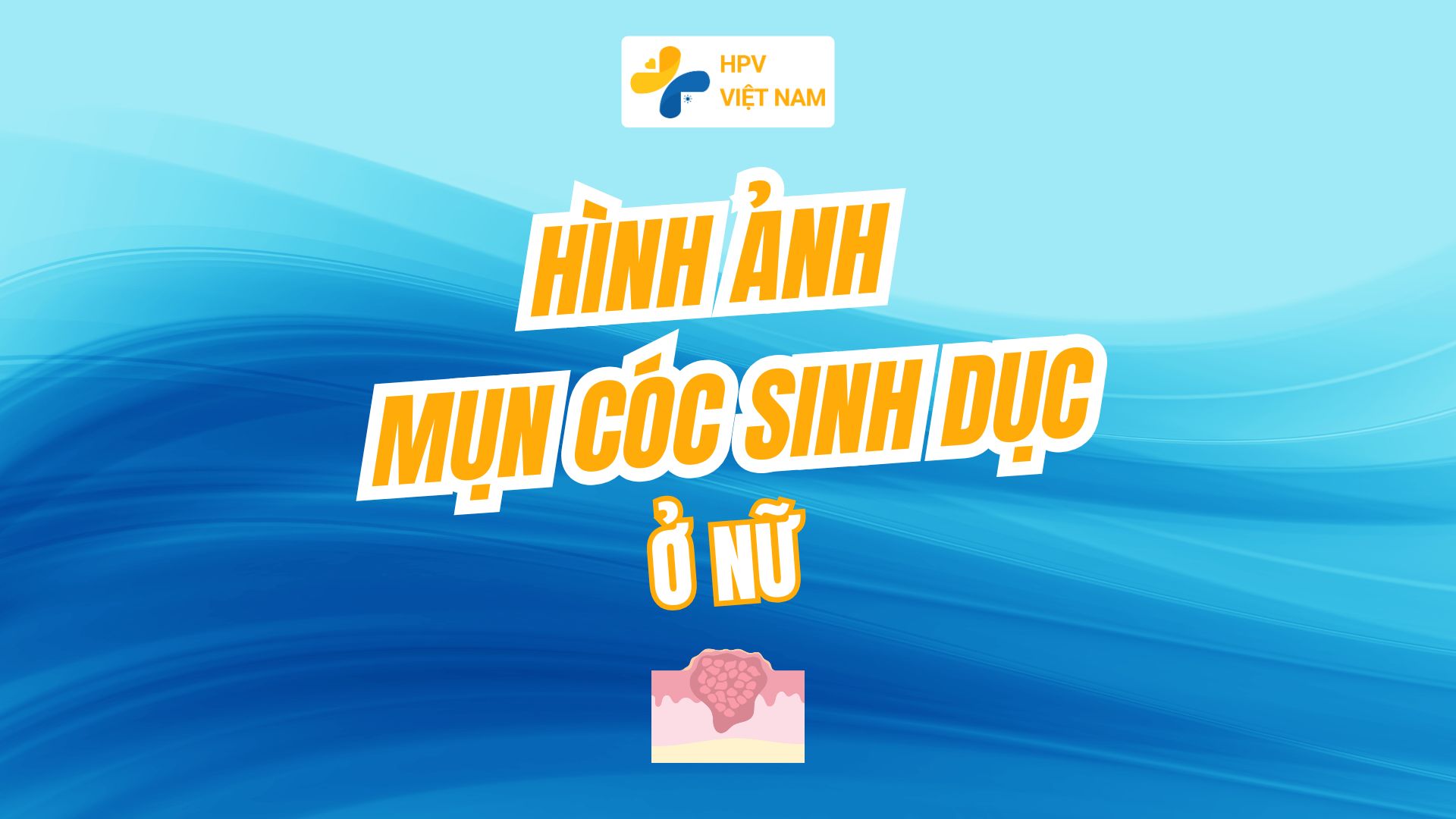 Hình ánh mụn cóc sinh dục ở nữ