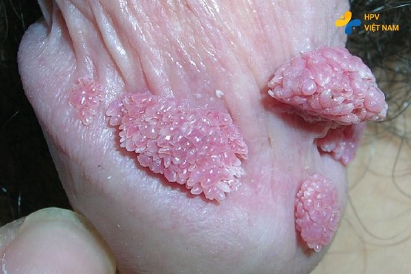 Ảnh sùi mào gào ở bao quy đầu