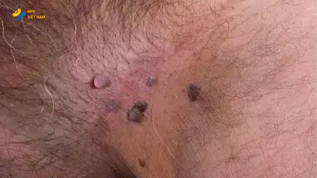 Hình ảnh sùi mào gà ở bìu và vùng mu