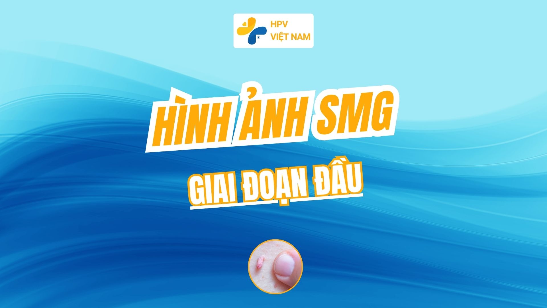 Hình ảnh ảnh sùi mào giai đoạn đầu