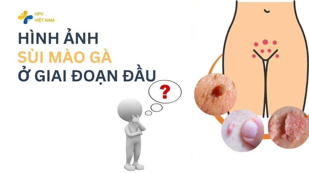 Hình ảnh ảnh sùi mào giai đoạn đầu