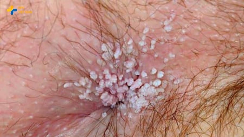 Hình ảnh sùi mào gà ở hậu môn