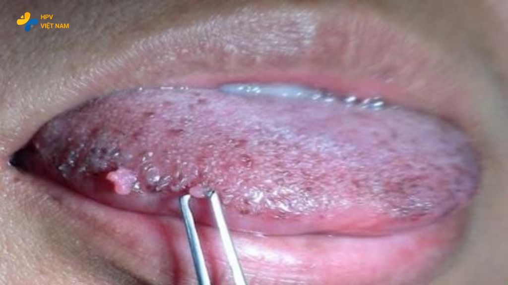 Hình ảnh sùi mào gà giai đoạn đầu ở miệng