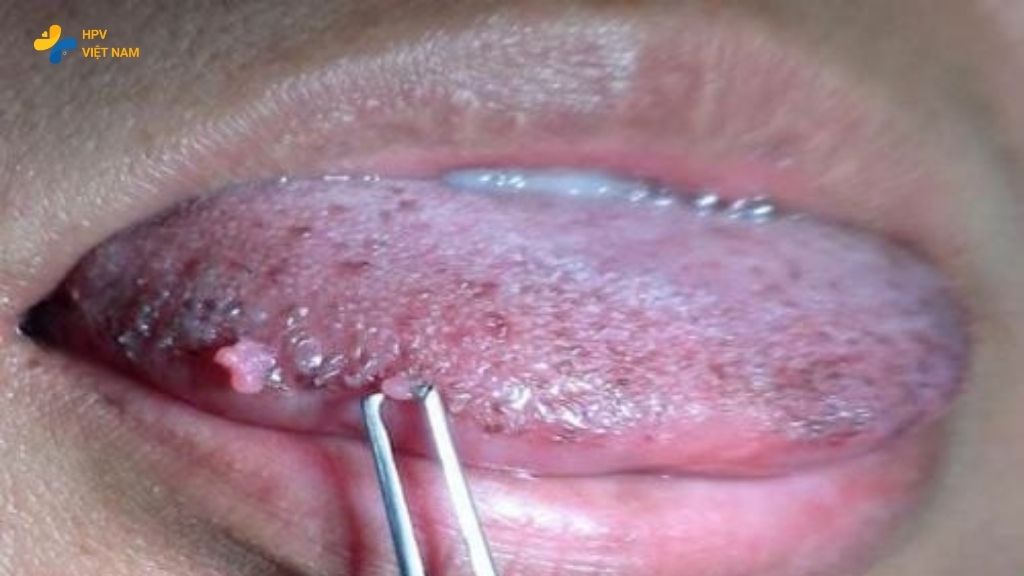 Hình ảnh sùi mào gà ở miệng