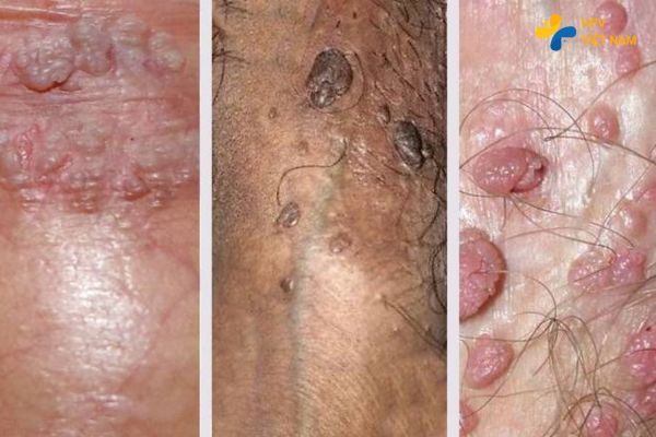 Hình ảnh sùi mào gà ở nam giới