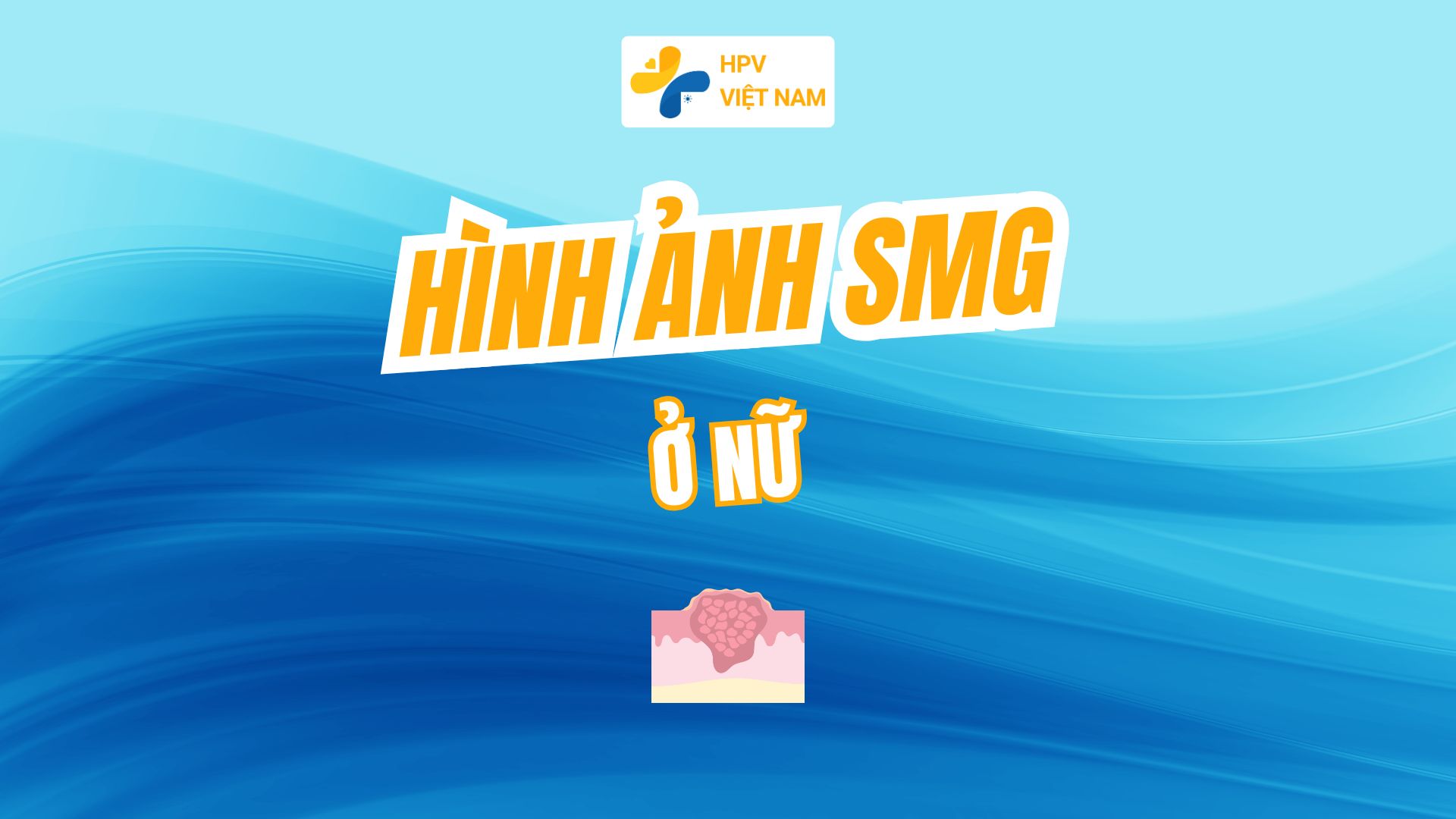 Hình ảnh sùi mào gà ở nữ