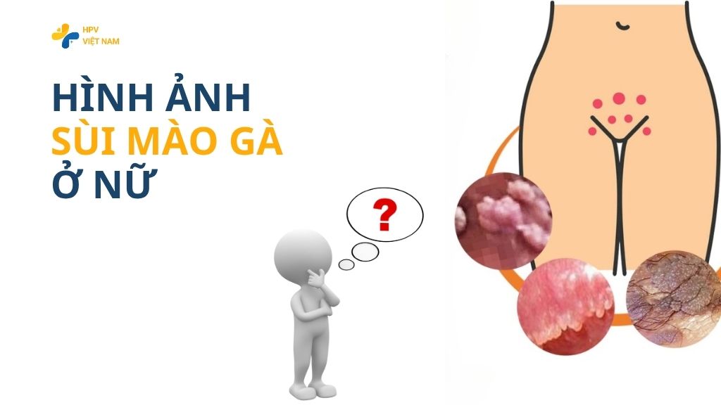 Hình ảnh sùi mào gà ở nữ
