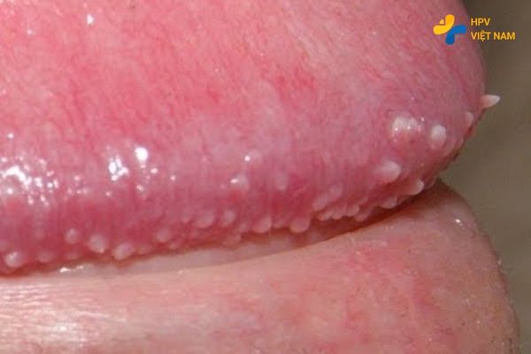 Hình ảnh sùi mào gà ở rãnh bao quy đầu