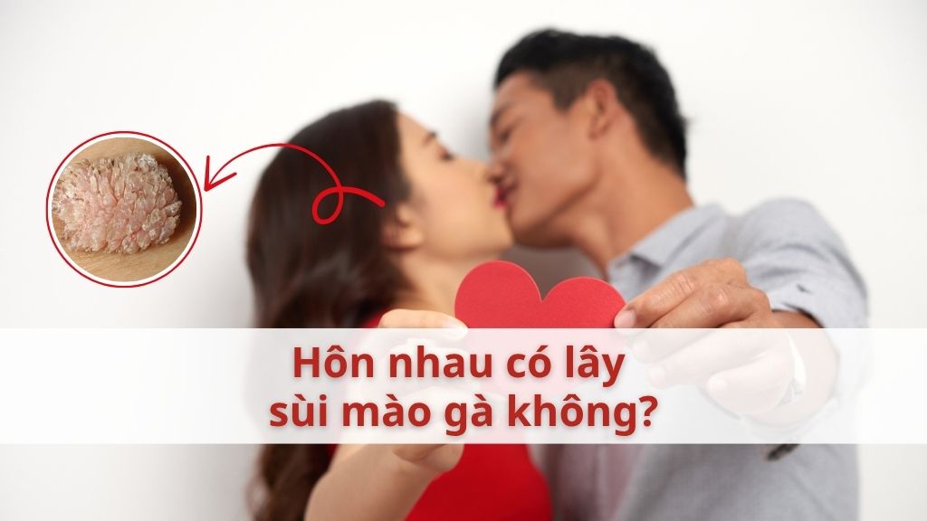 Hôn nhau có lây sùi mào gà không