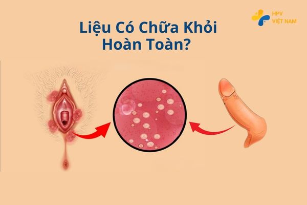 Liệu có chữa khỏi sùi mào gà hoàn toàn được không?