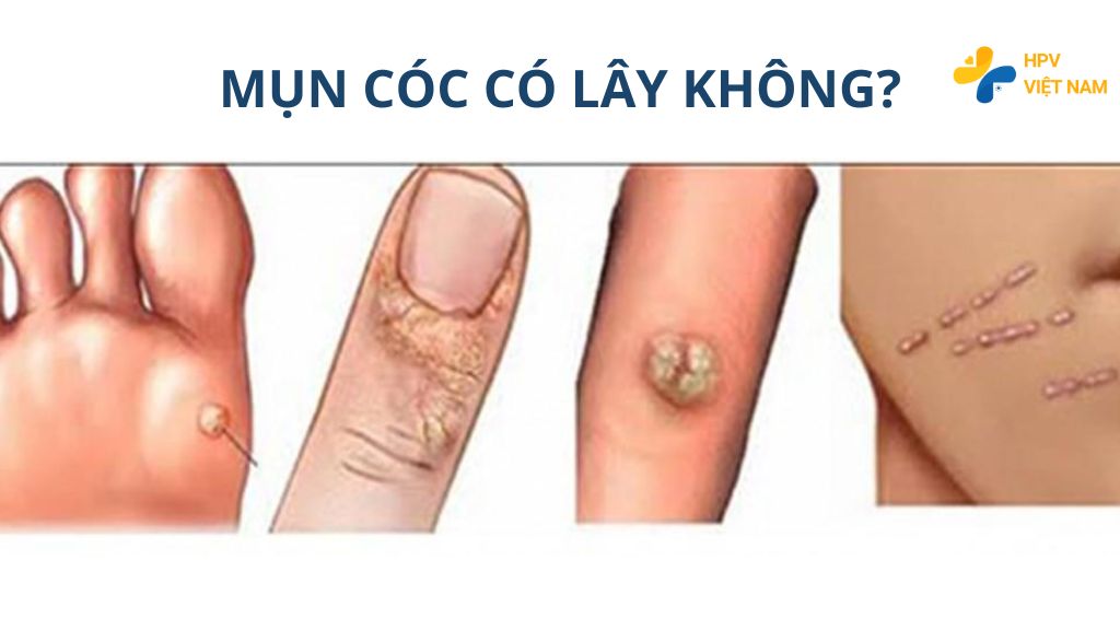 Mụn cóc có lây không?