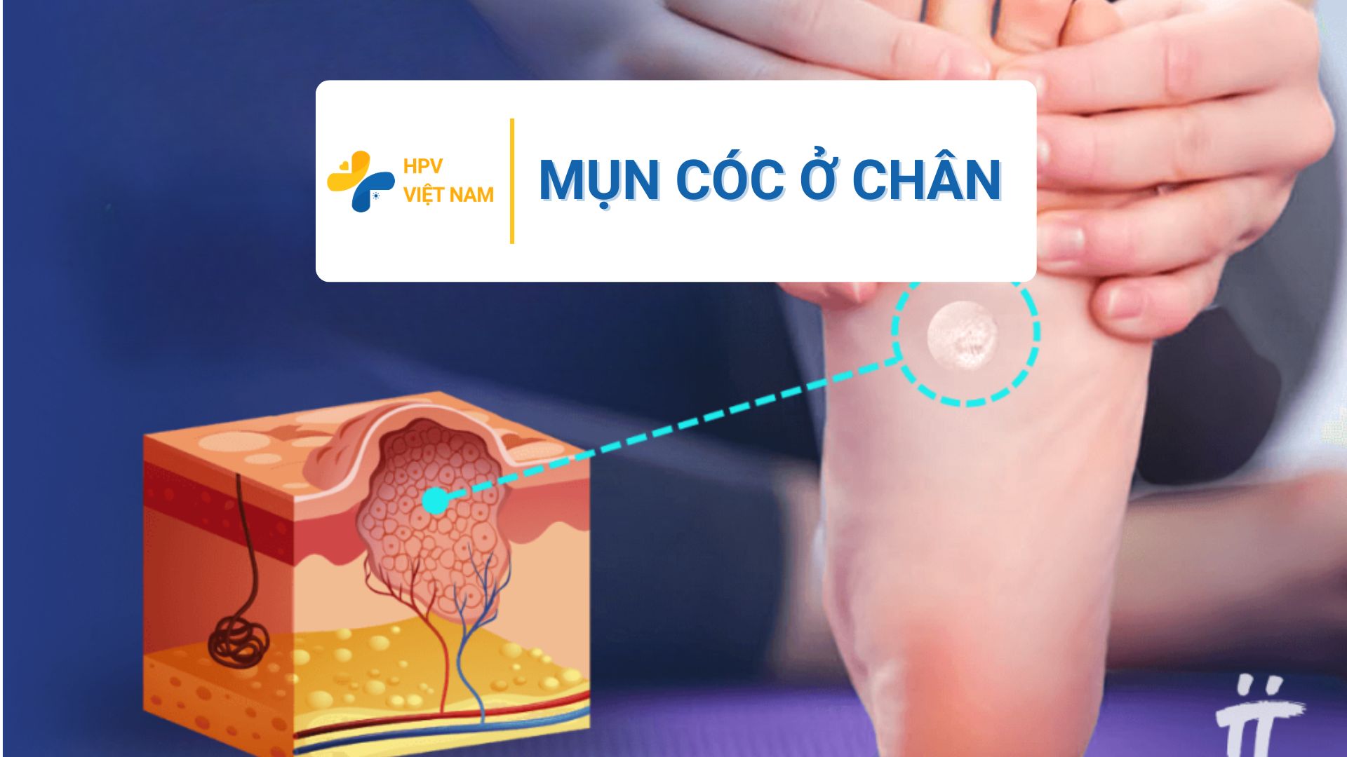 Mụn cóc ở chân có nguy hiểm không?