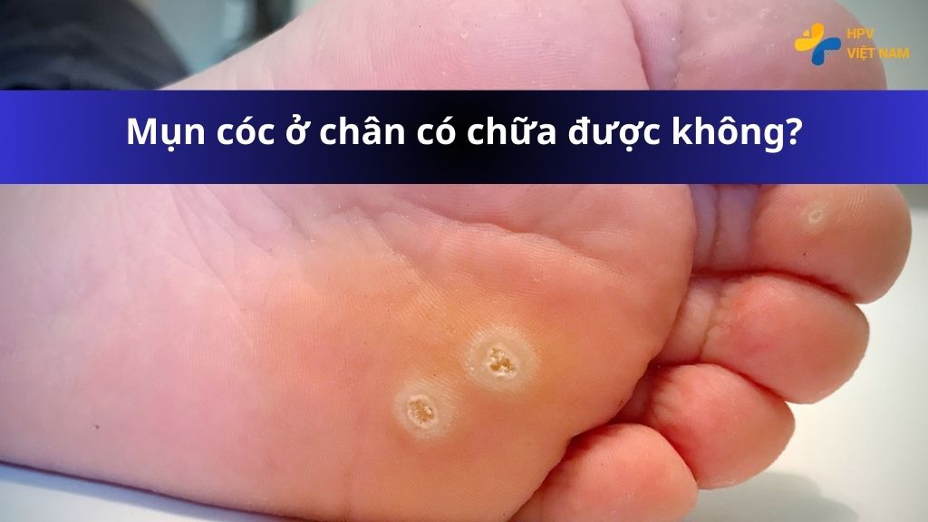 Mụn cóc ở chân có chữa được không?