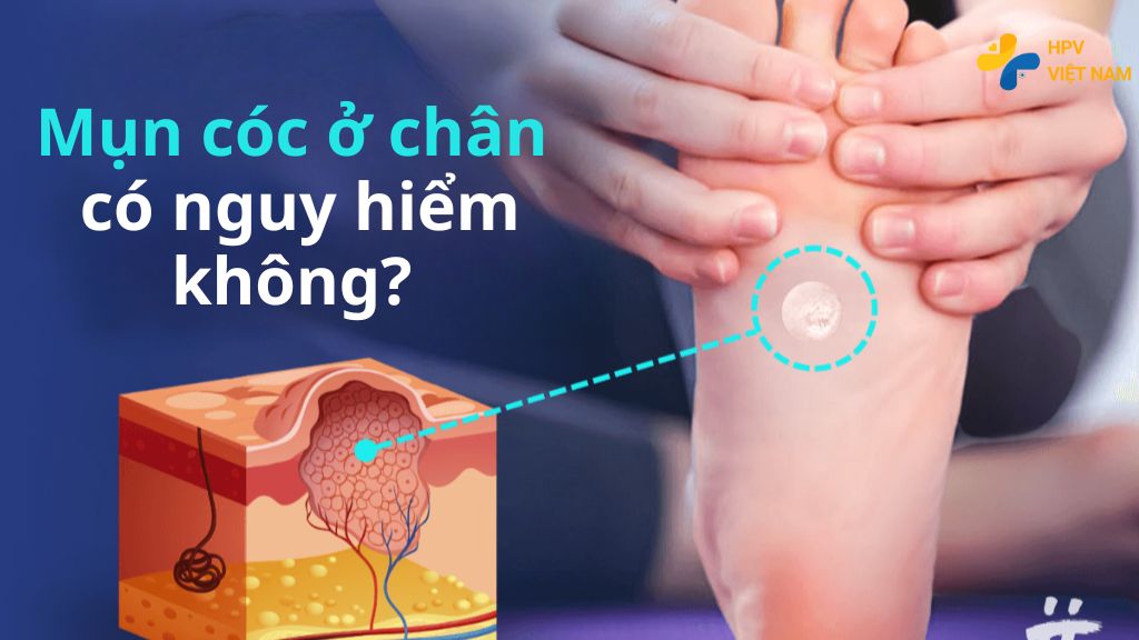 Mụn cóc ở chân có nguy hiểm không?
