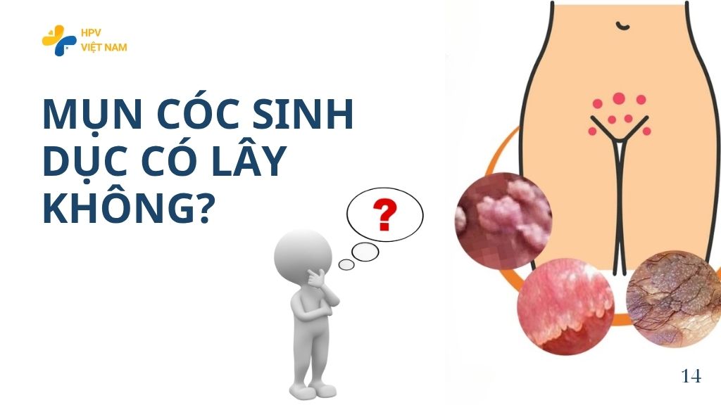 mụn cóc sinh dục có lây không 