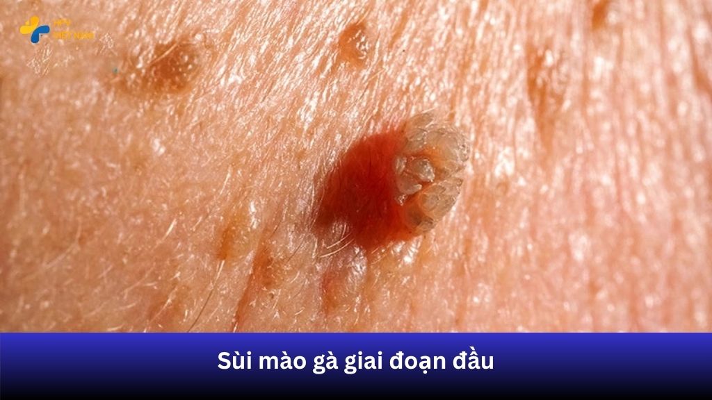 Mụn cóc sinh dục giai đoạn đầu