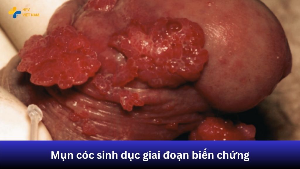 Hình ảnh mụn cóc sinh dục giai đoạn biến chứng