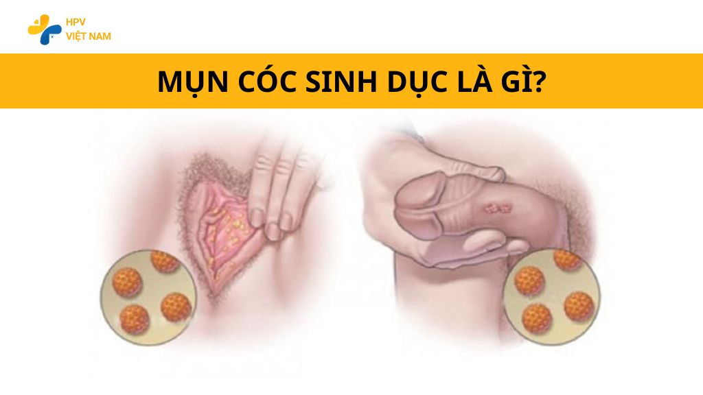 Mụn cóc sinh dục là gì?