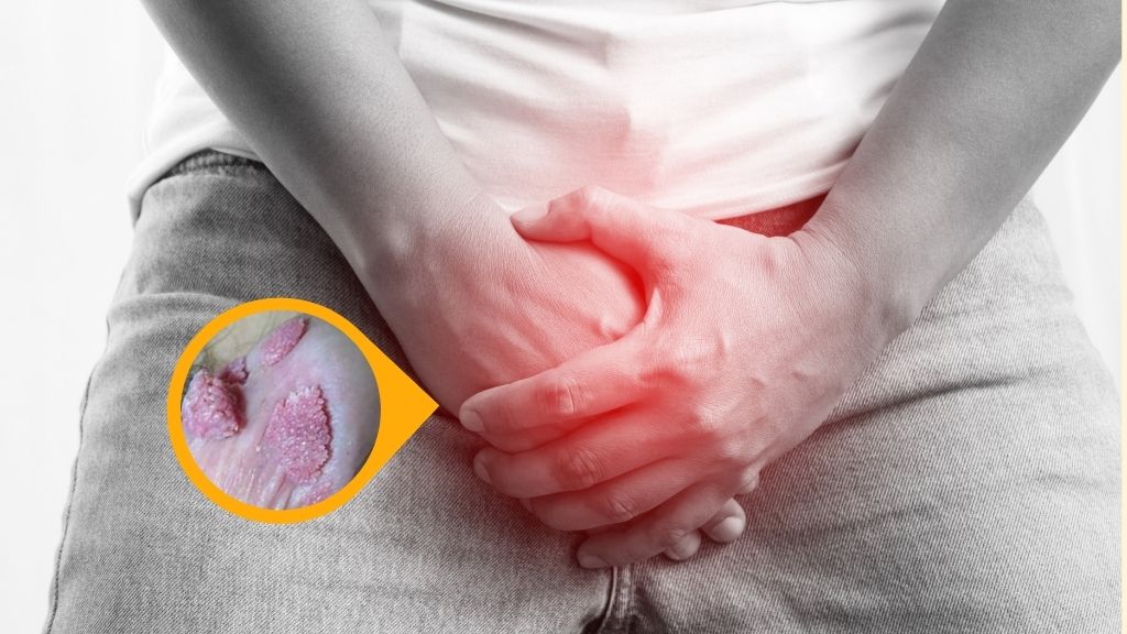 Mụn cóc sinh dục nam là gì?