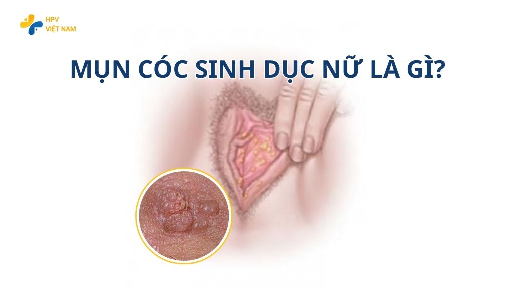 Mụn cóc sinh dục nữ là gì?