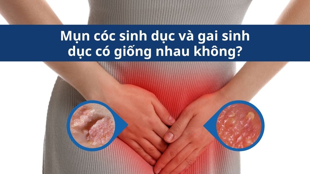 Mụn cóc sinh dục và gai sinh dục có giống nhau không?