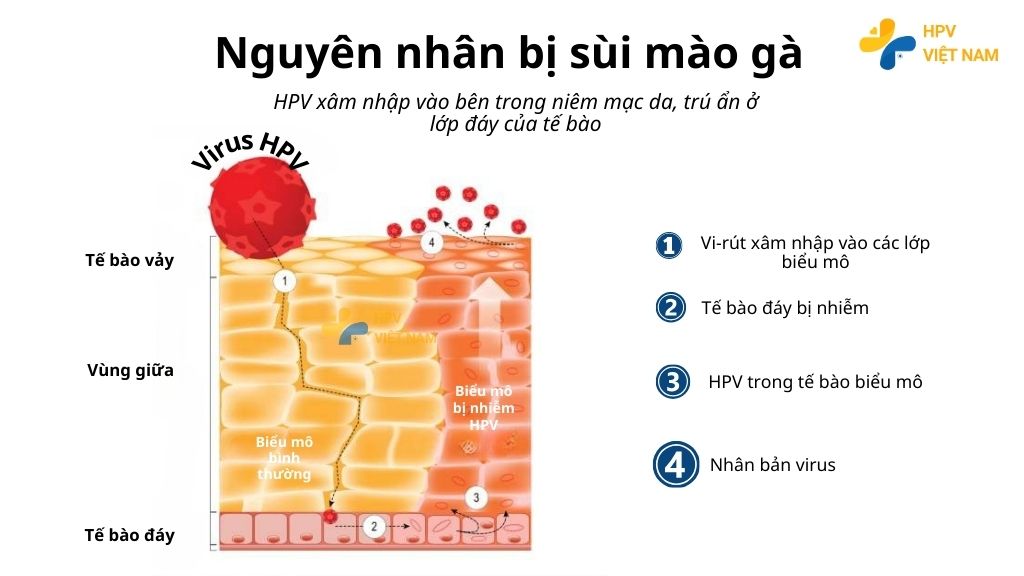 Nguyên nhân bị sùi mào gà