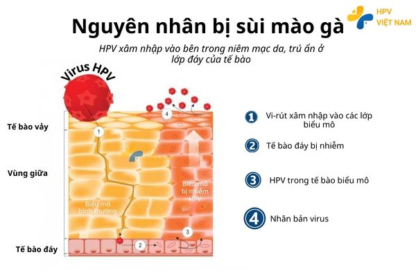 Nguyên nhân của sùi mào gà