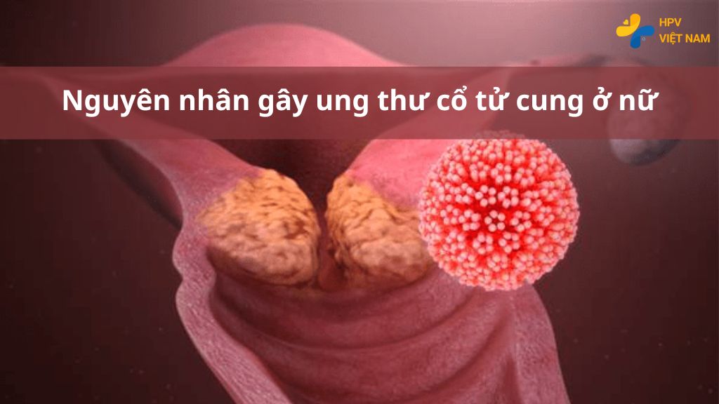 Nguyên nhân gây ung thư cổ tử cung