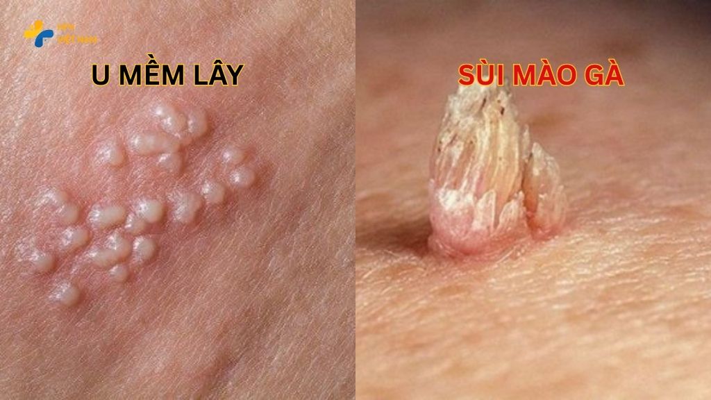 Phân biệt u mềm lây và sùi mào gà 